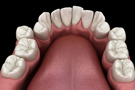 Illustration of crooked teeth
