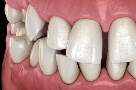 Illustration of gapped teeth