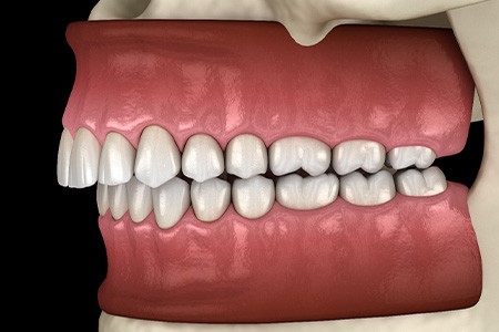 Illustration of an overbite