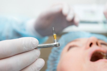 A dental implant in the hands of a dentist