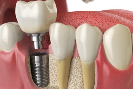 A 3D illustration of a dental implant and its parts