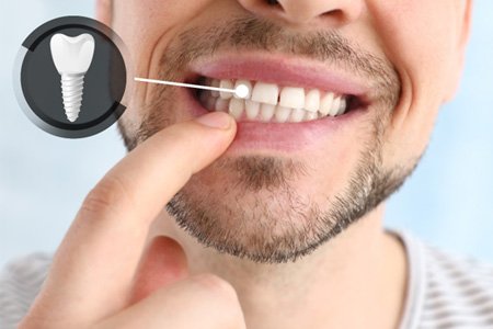 : A man showing his implanted tooth against a light background