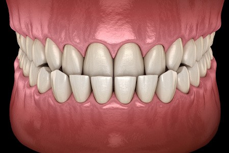 Illustration of an underbite