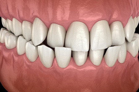 Illustration of a crossbite