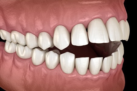 Illustration of an open bite