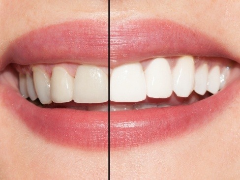 Smile before and after KoR teeth whitening