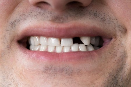 a man smiling and missing a single tooth
