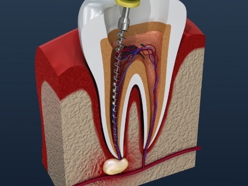 Animated tooth during root canal therapy