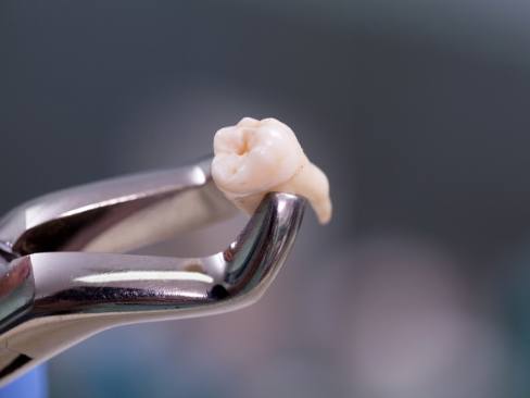 Metal clasp holding an extracted tooth