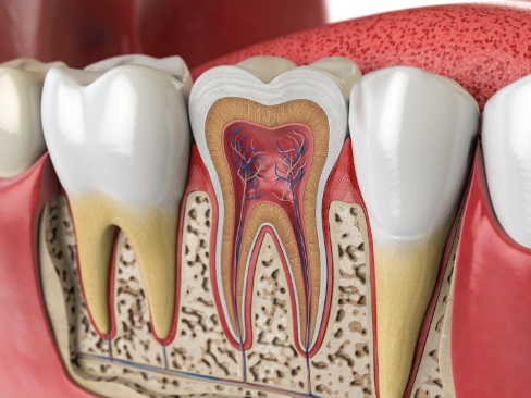 Animated smile in need of periodontal maintenance