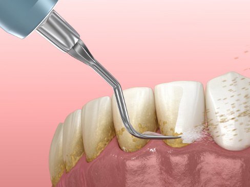 Animated smile during scaling and root planing treatment