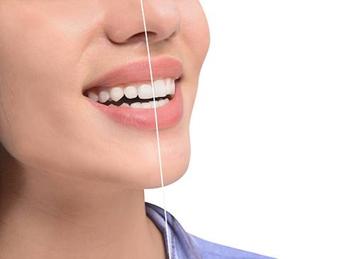 Woman’s smile before and after gum recontouring