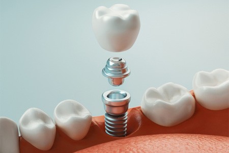 parts of implant representing cost of dental implants in Dallas