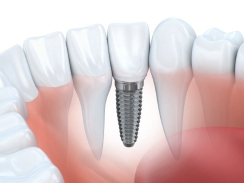 Animated smile with dental implant supported dental crown