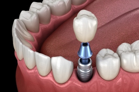 Animated smile during single tooth dental implant placement
