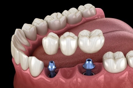 Animated smile during multiple tooth dental implant placement