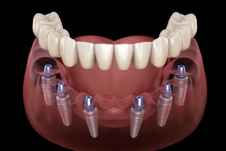 Animated smile during dental implant supported denture placement