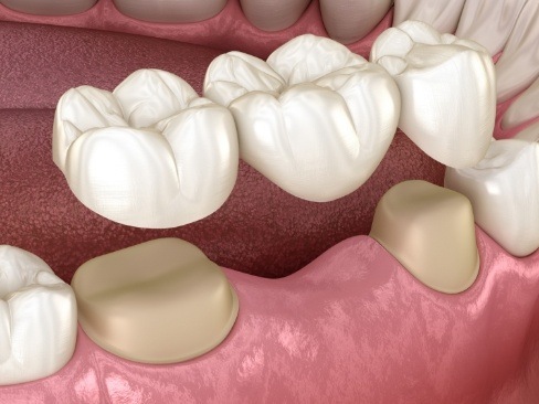 Animated smile during dental bridge placement