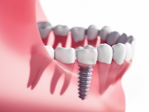 Animated smile with dental implant supported dental crown