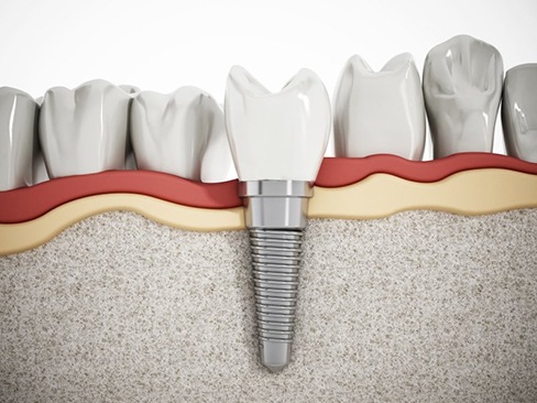 a 3 D digital illustration of a dental implant