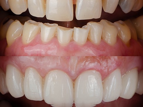 Veneers to close a gap in Dallas