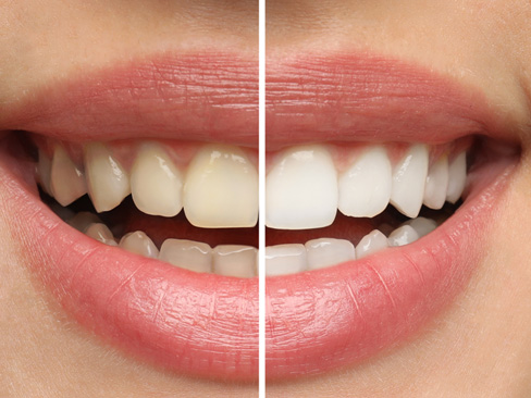 Closeup of patient's teeth before and after teeth whitening