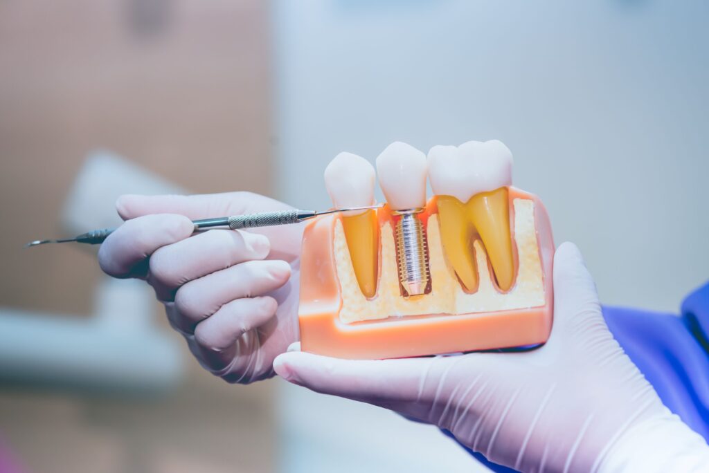 Gloved hands pointing to sample dental implant with dental instrument