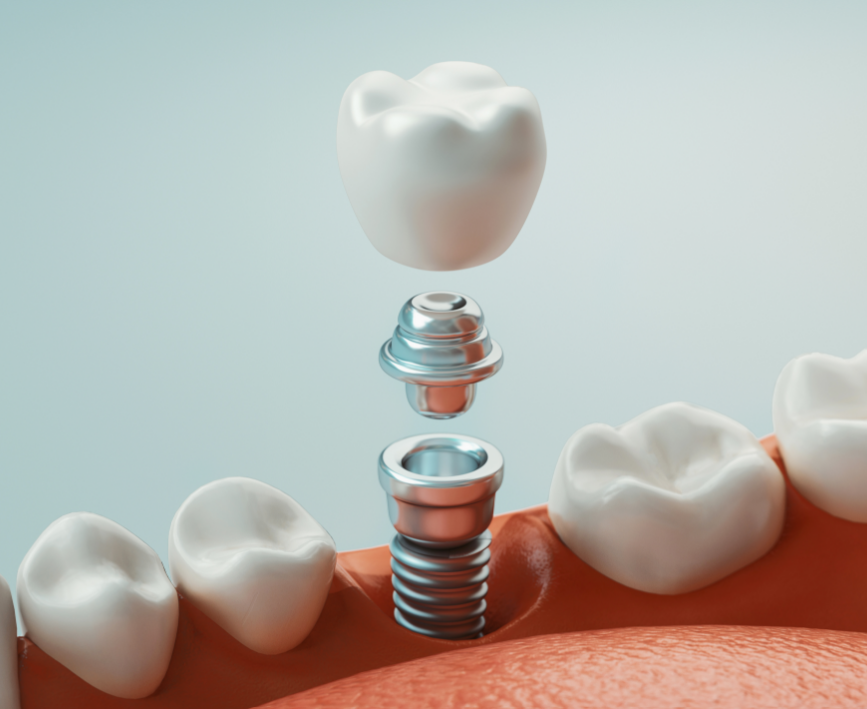 3D image of a dental implant