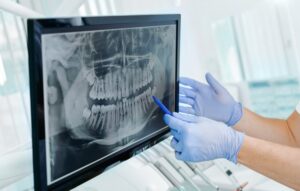 Dentist looking at patient's wisdom teeth on an X-ray