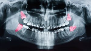 Oral X-ray highlighting wisdom teeth in red.